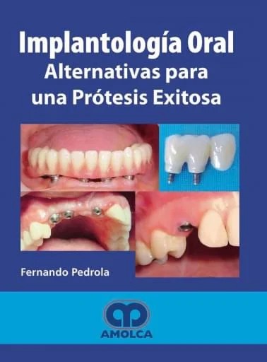 IMPLANTOLOGÍA ORAL. ALTERNATIVAS PARA UNA PRÓTESIS EXITOSA.