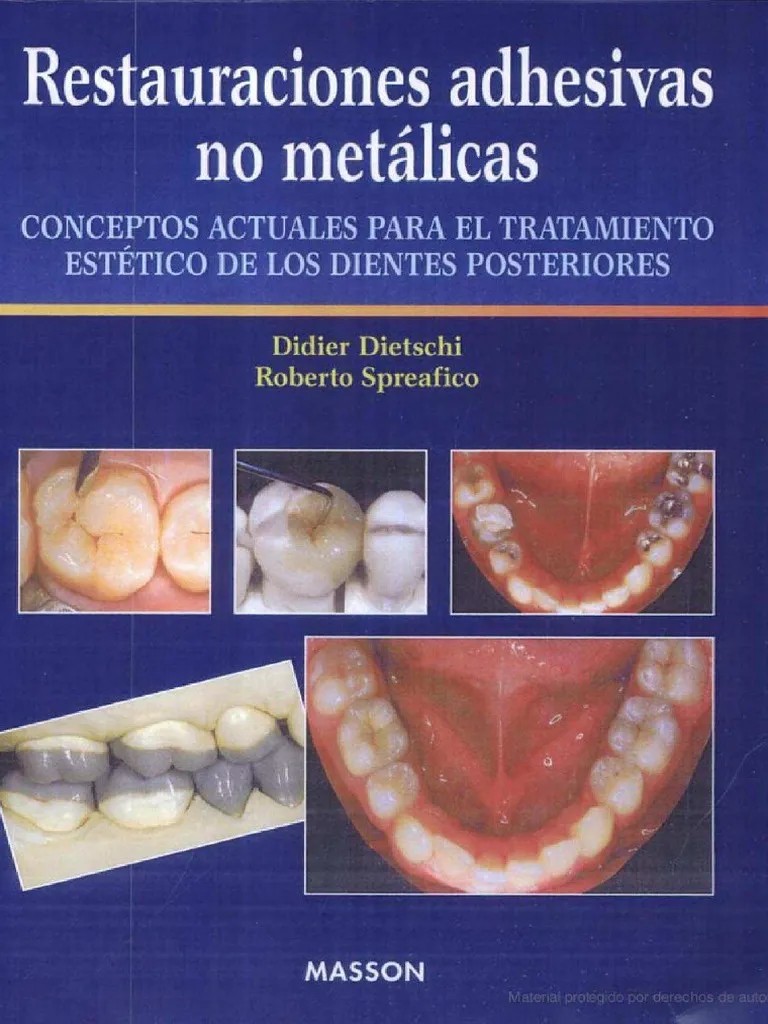 RESTAURACIONES ADHESIVAS NO METÁLICAS. CONCEPTOS ACTUALES PARA EL TRATAMIENTO ESTÉTICO DE LOS DIENTES POSTERIORES.