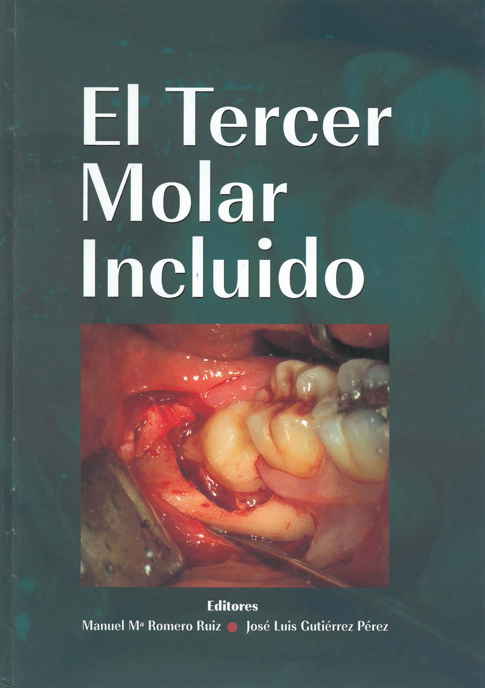 EL TERCER MOLAR INCLUIDO