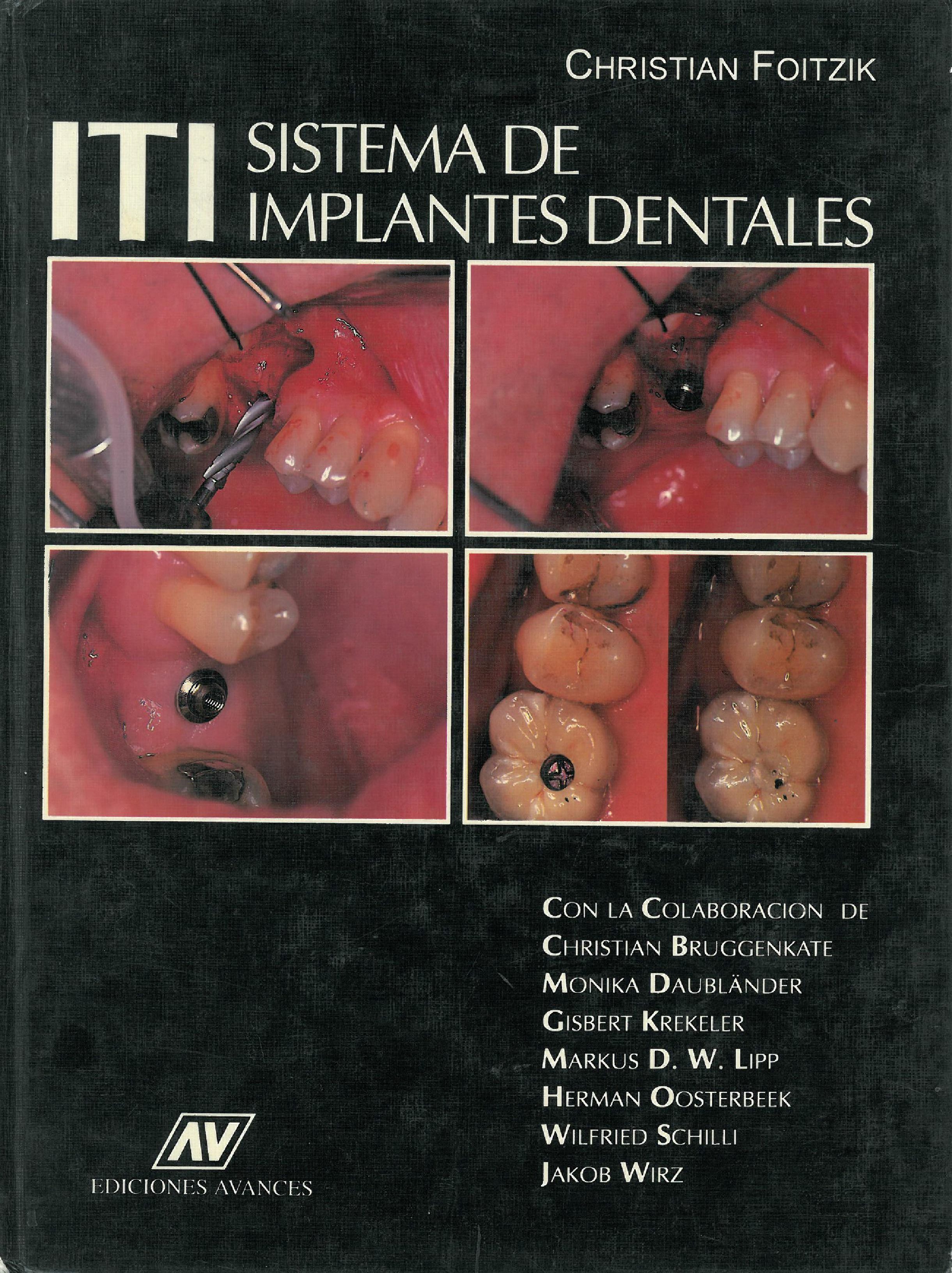 SISTEMA DE IMPLANTES DENTALES