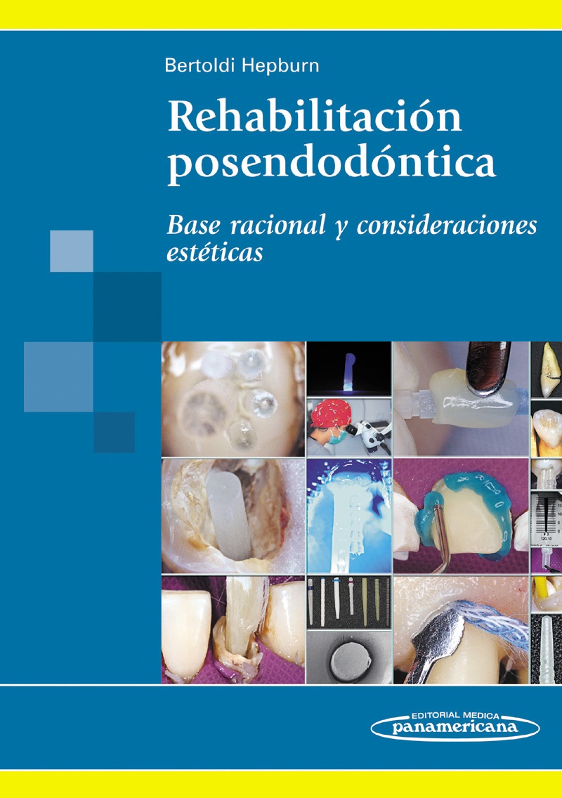 REHABILITACIÓN POSENDODÓNTICA. BASE RACIONAL Y CONSIDERACIONES ESTÉTICAS.