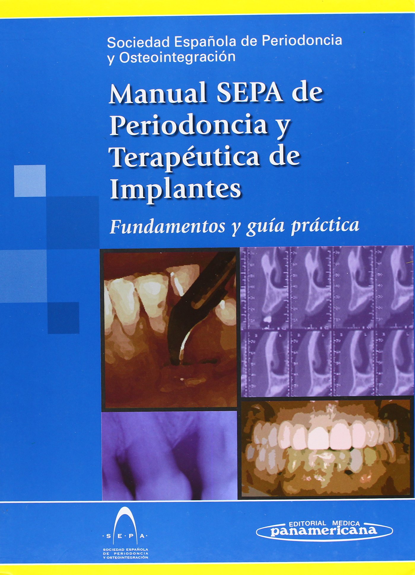 MANUAL SEPA DE PERIODONCIA Y TERAPÉUTICA DE IMPLANTES: FUNDAMENTOS Y GUÍA