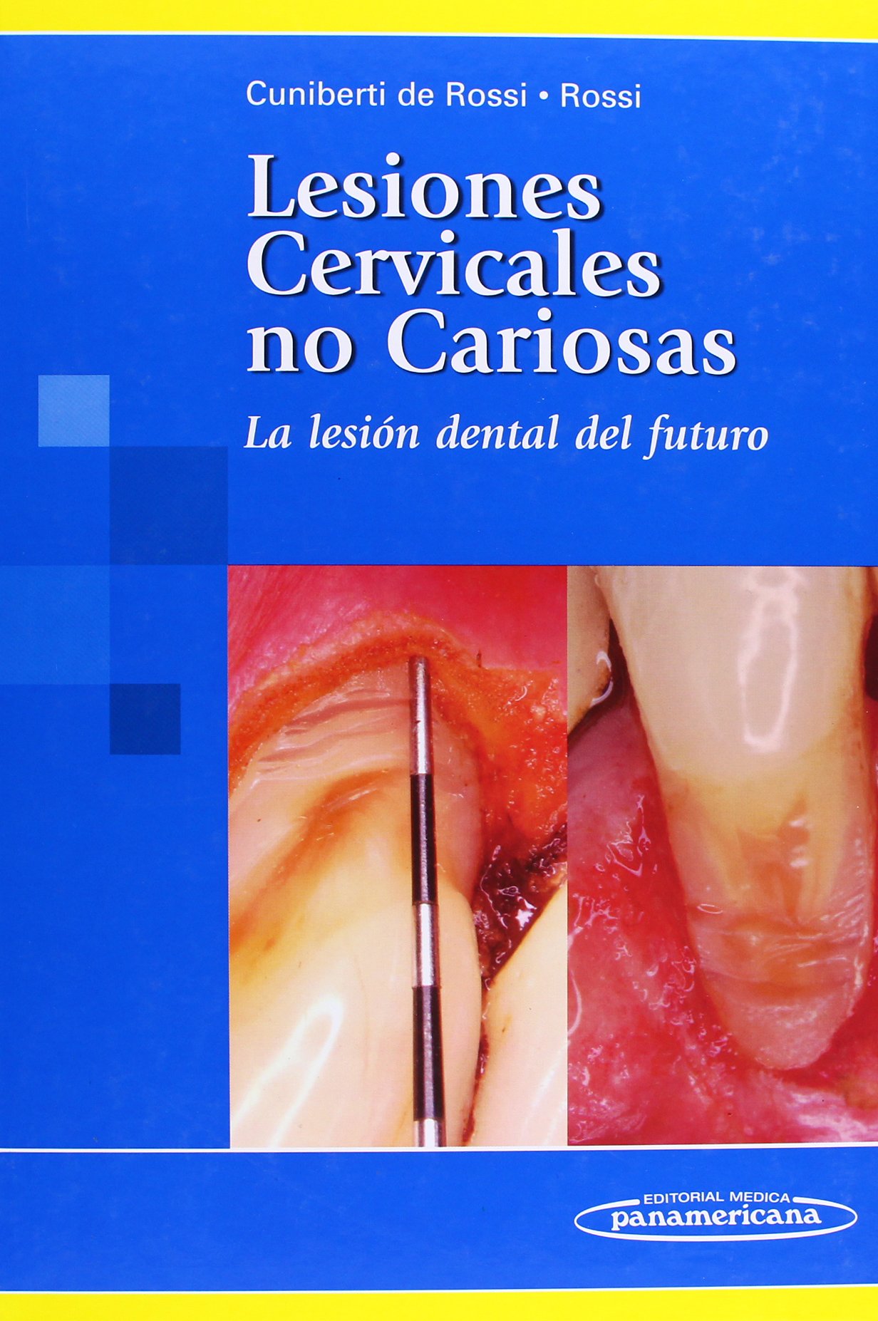 LESIONES CERVICALES NO CARIOSAS. LA LESIÓN DENTAL DEL FUTURO.
