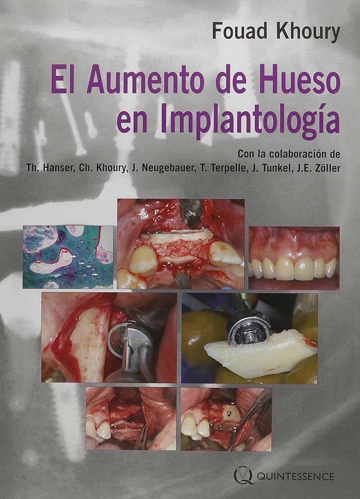 EL AUMENTO DE HUESO EN IMPLANTOLOGÍA
