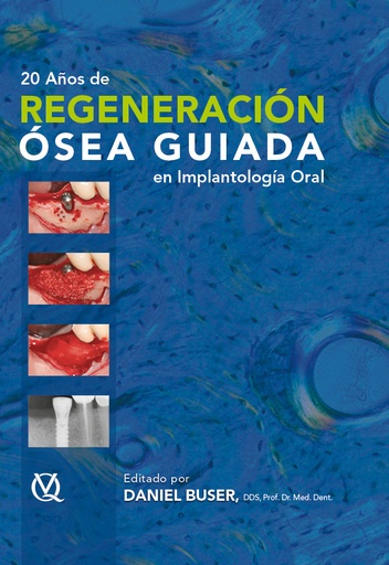 REGENERACIÓN ÓSEA GUIADA EN IMPLANTOLOGÍA ORAL