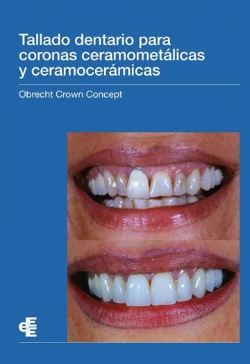 TALLADO DENTARIO PARA CORONAS CERAMOMETÁLICAS Y CERAMOCERÁMICAS