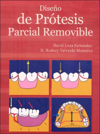 DISEÑO DE PRÓTESIS PARCIAL REMOVIBLE