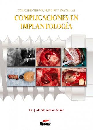 COMO IDENTIFICAR, PREVENIR Y TRATAR LAS COMPLICACIONES EN IMPLANTOLOGÍA