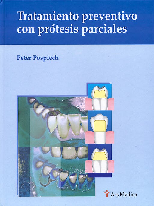 TRATAMIENTO PREVENTIVO CON PRÓTESIS PARCIALES