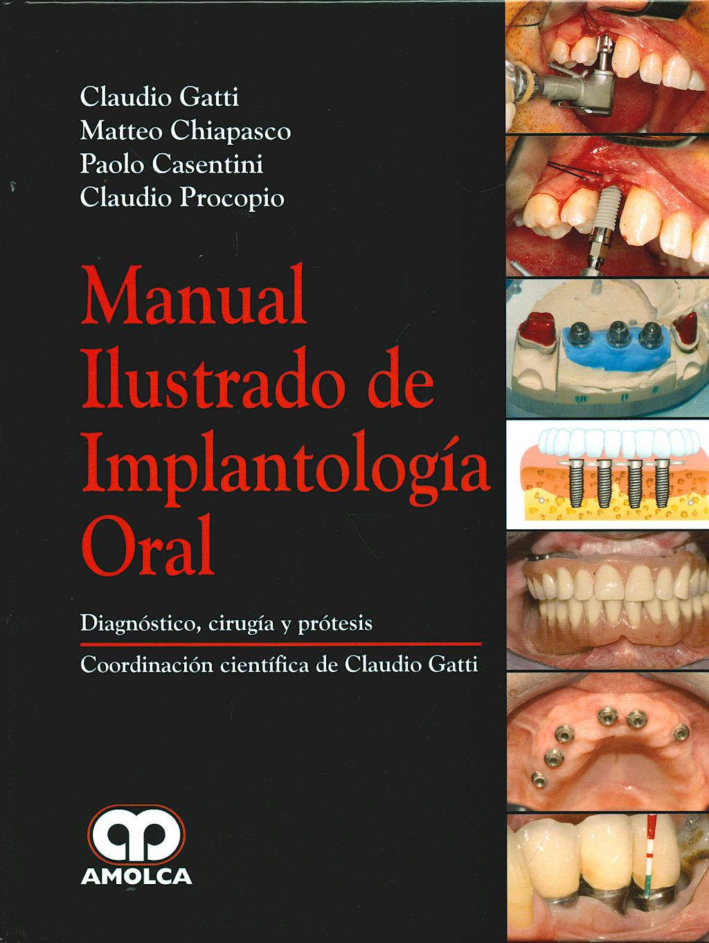 MANUAL ILUSTRADO DE IMPLANTOLOGÍA ORAL. DIAGNÓSTICO, CIRUGÍA Y PRÓTESIS.