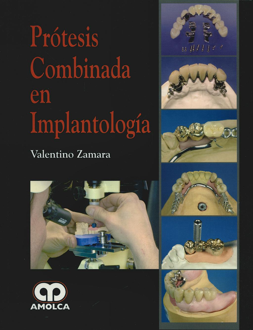 PRÓTESIS COMBINADA EN IMPLANTOLOGÍA