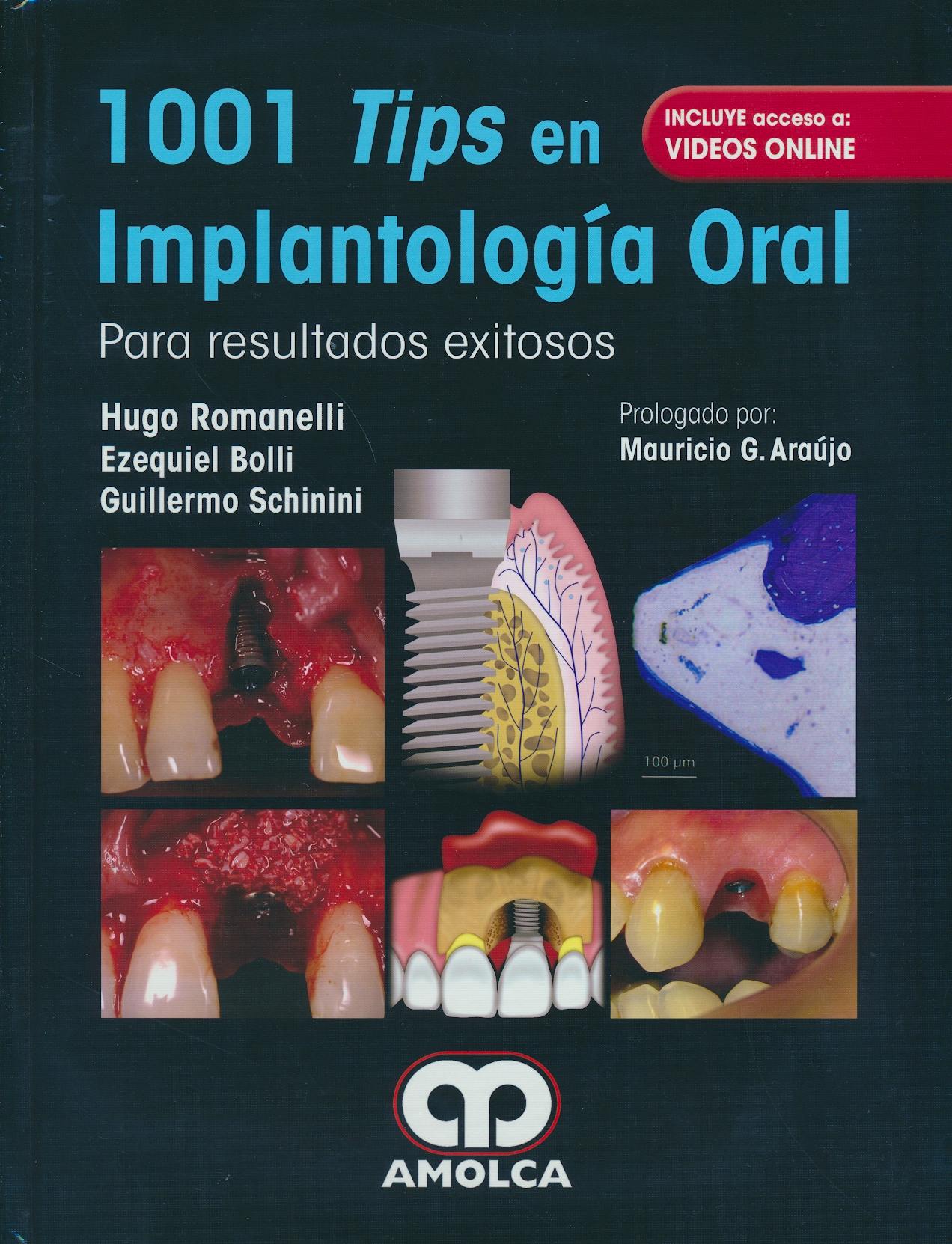 1 001 TIPS EN IMPLANTOLOGÍA ORAL PARA RESULTADOS EXITOSOS