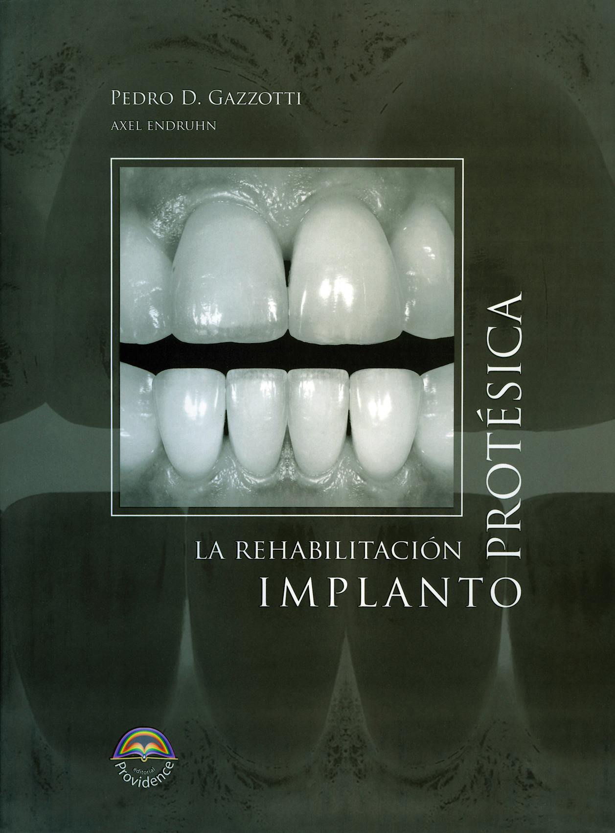 LA REHABILITACIÓN IMPLANTOPROTÉSICA