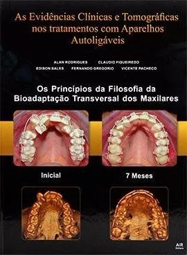 AS EVIDÊNCIAS CLÍNICAS E TOMOGRÁFICAS NOS TRATAMENTOS COM APARELHOS AUTOLIGÁVEIS