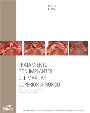 TRATAMIENTO CON IMPLANTES DEL MAXILAR SUPERIOR ATRÓFICO