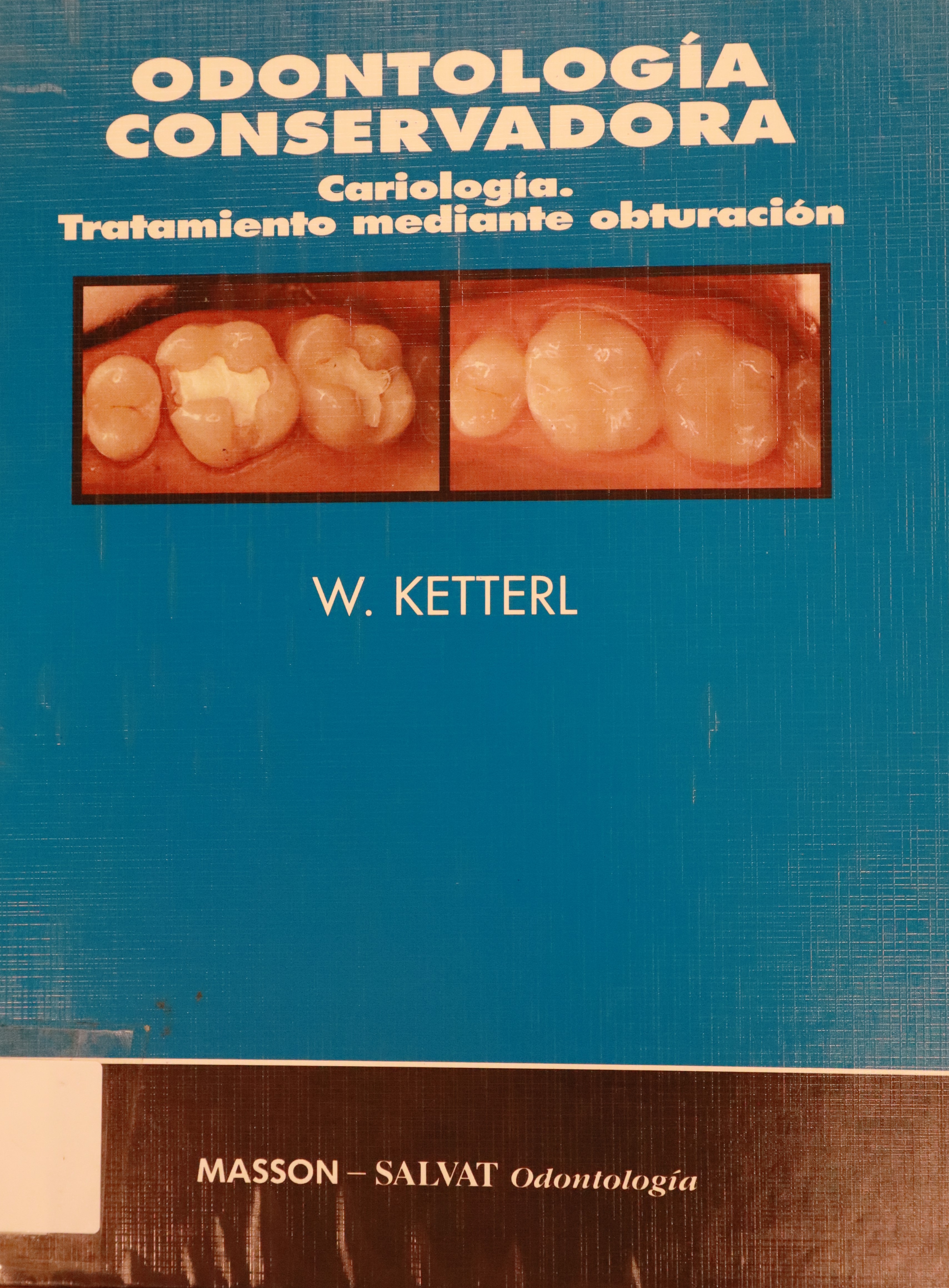 ODONTOLOGÍA CONSERVADORA: CARIOLOGÍA Y TRATAMIENTO MEDIANTE OBTURACIÓN