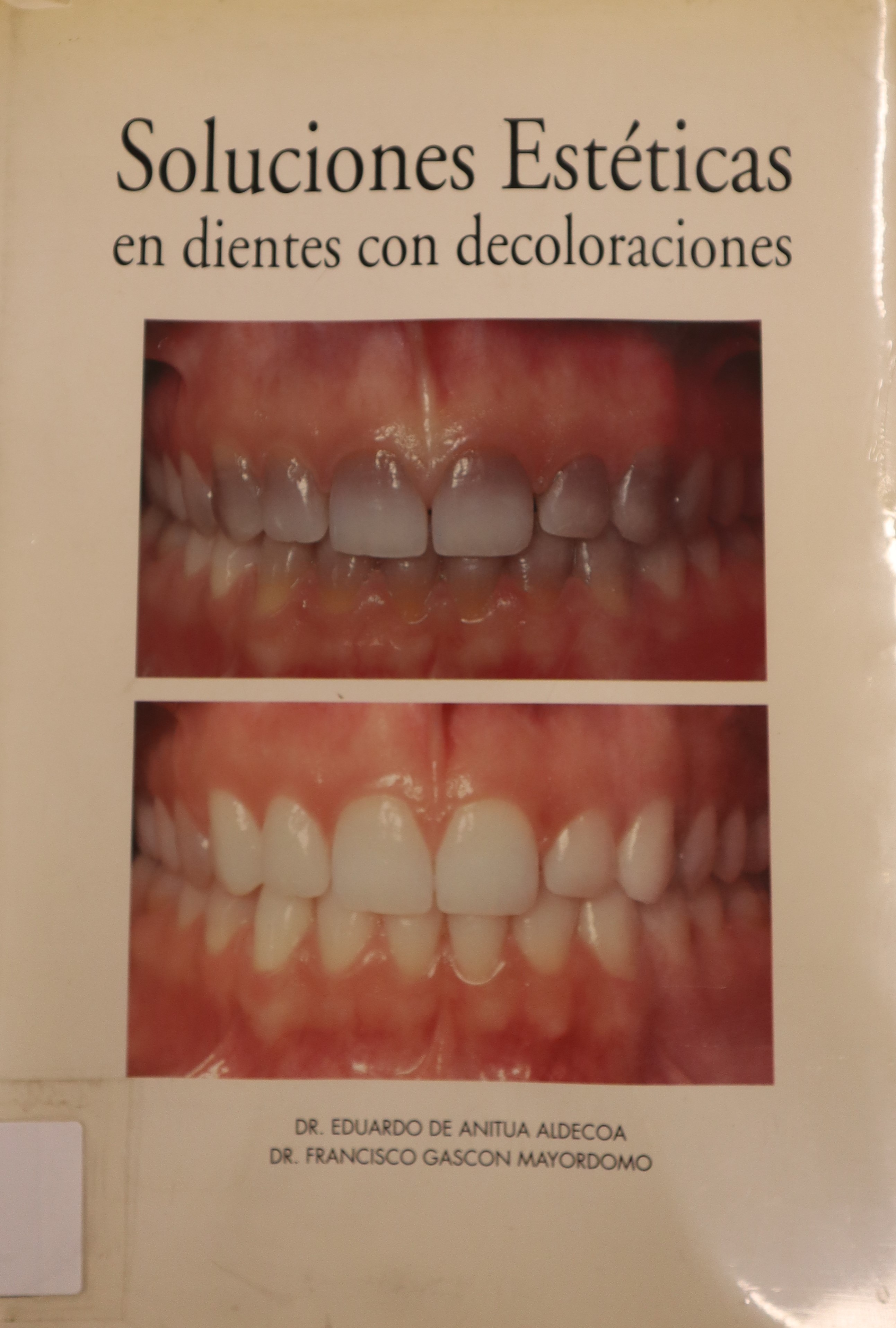 SOLUCIONES ESTÉTICAS EN DIENTES CON DECOLORACIONES