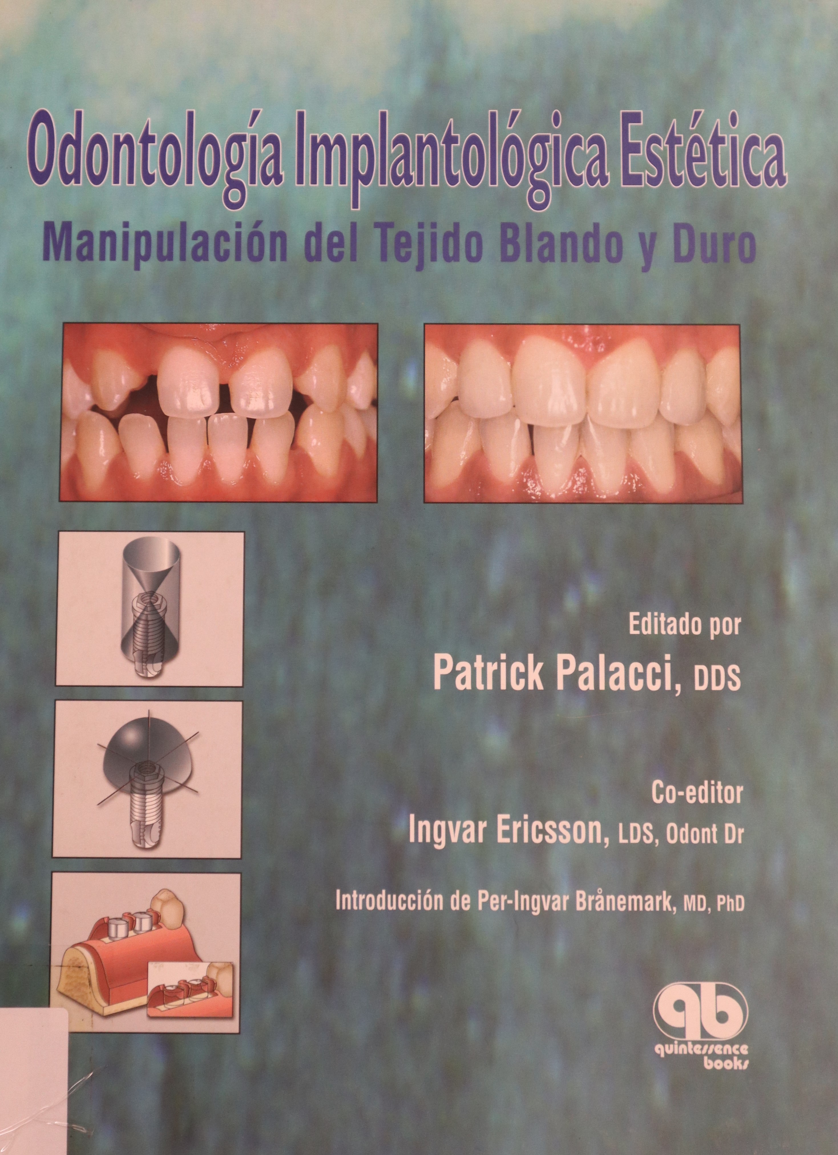 ODONTOLOGÍA IMPLANTOLÓGICA ESTÉTICA MANIPULACIÓN DEL TEJIDO BLANDO Y DURO