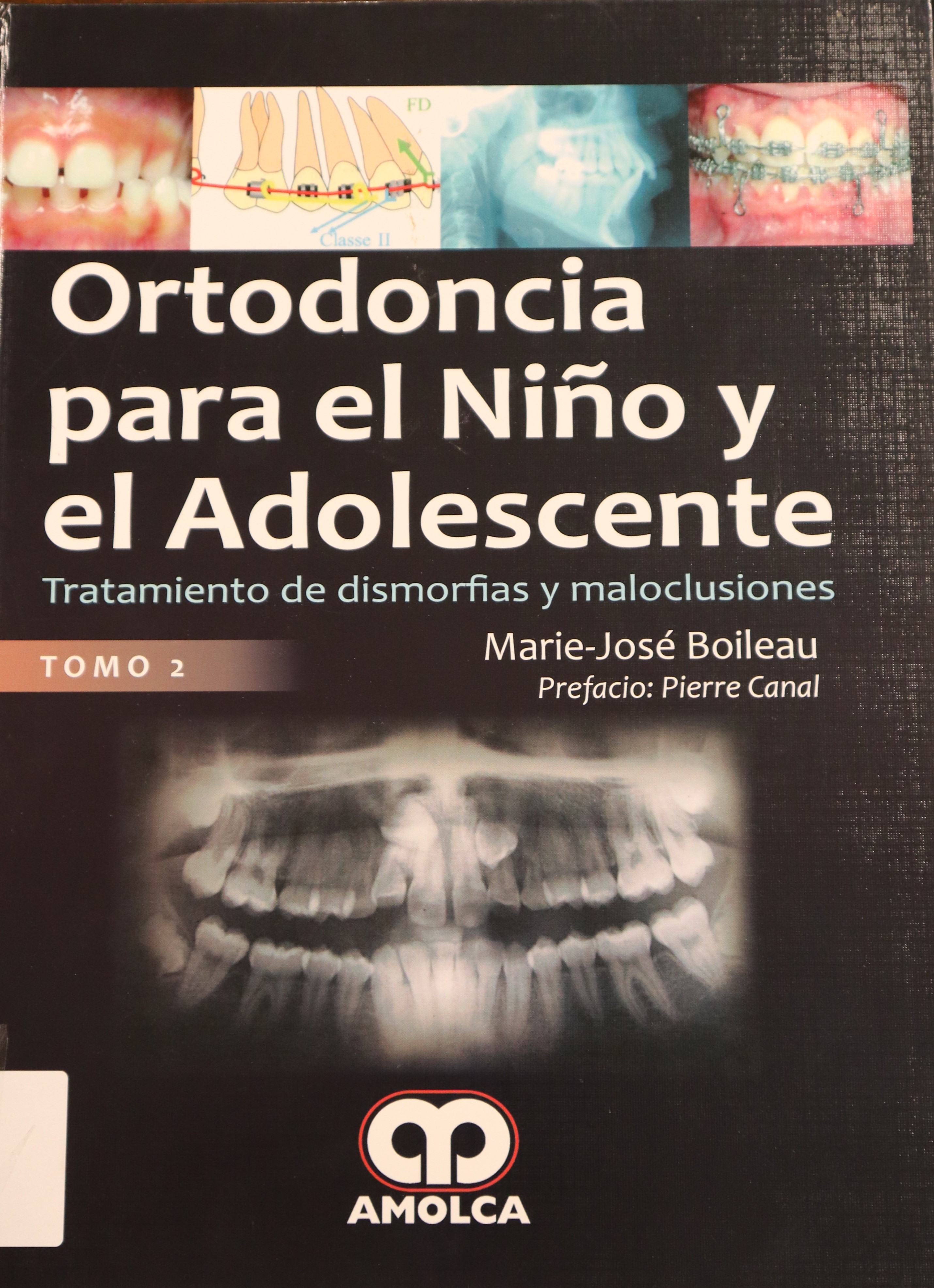 ORTODONCIA PARA EL NIÑO Y EL ADOLESCENTE: TRATAMIENTO DE DISMORFIAS Y MALOCLUSIONES TOMO II