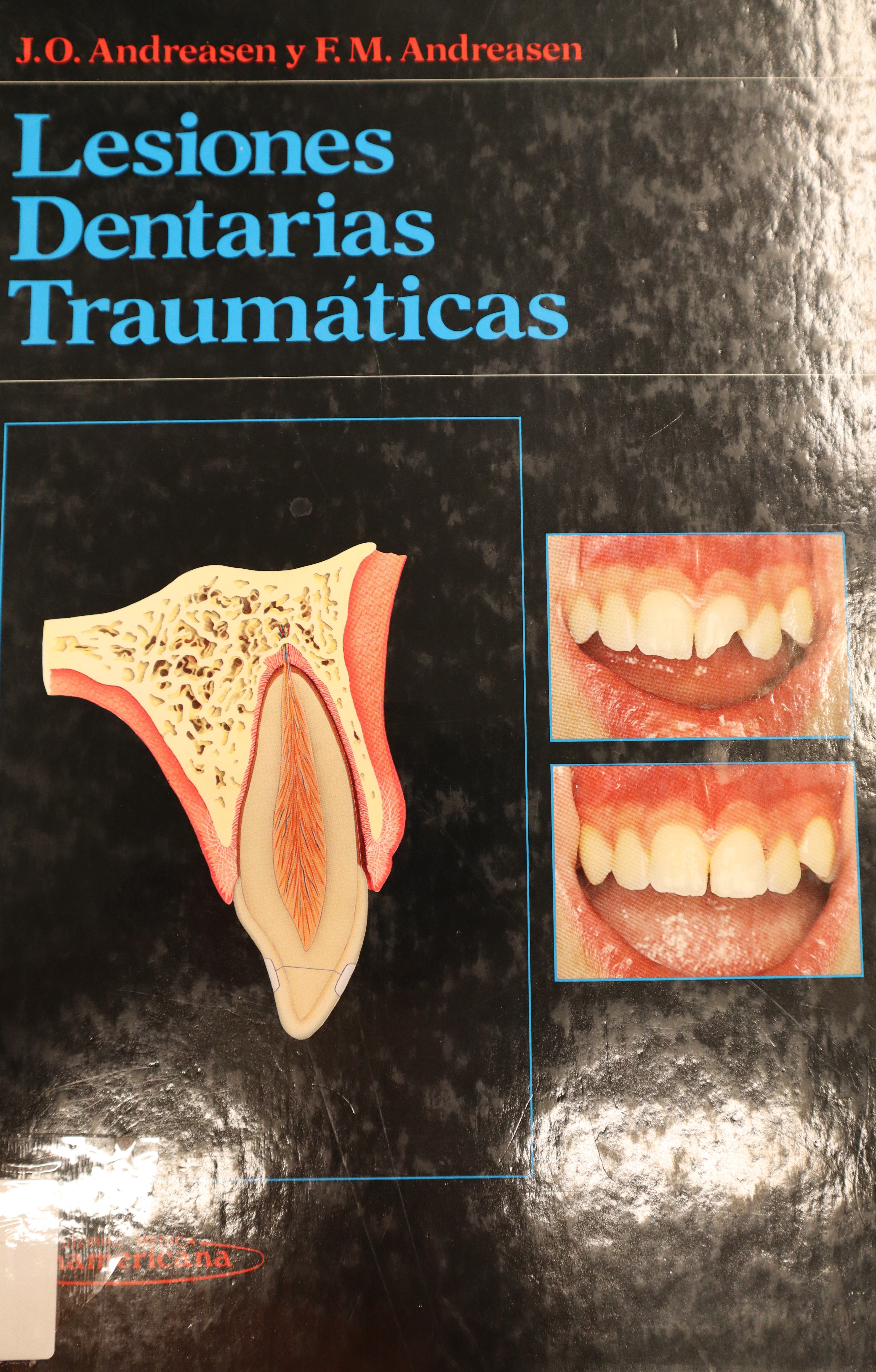 LESIONES DENTARIAS TRAUMÁTICAS