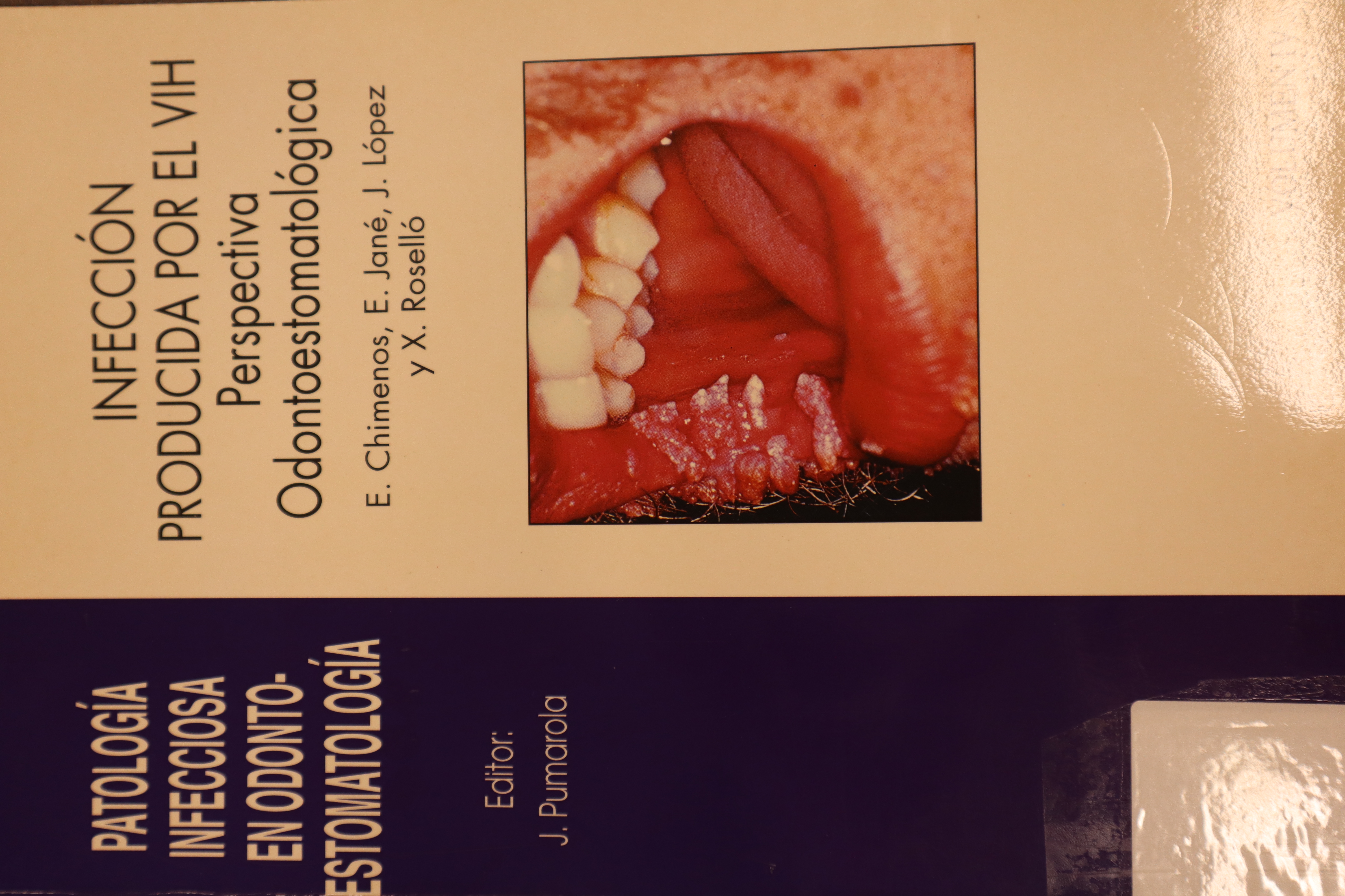 PATOLOGÍA INFECCIOSA EN ODONTO-ESTOMATOLOGÍA. INFECCIÓN PRODUCIDA POR EL VIH. PERSPECTIVA ODONTOESTOMATOLÓGICA. VOL. IV.