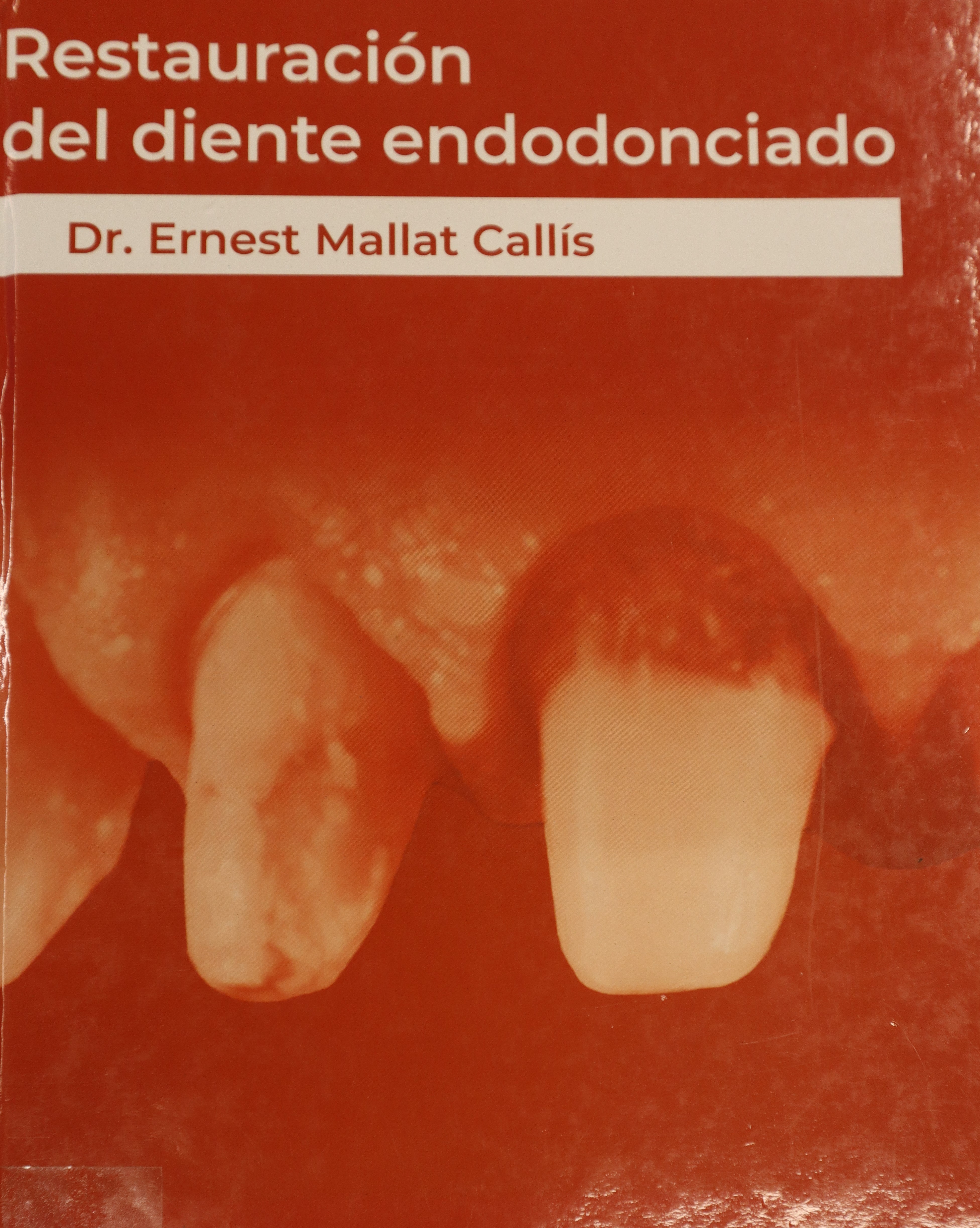 RESTAURACIÓN DEL DIENTE ENDODONCIADO 2ª EDICIÓN