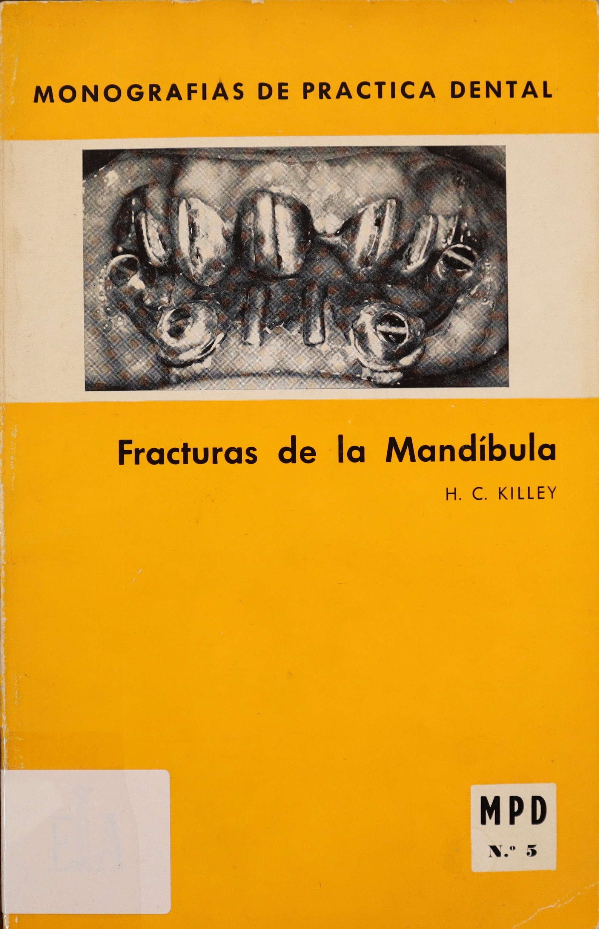 FRACTURAS DE LA MANDÍBULA