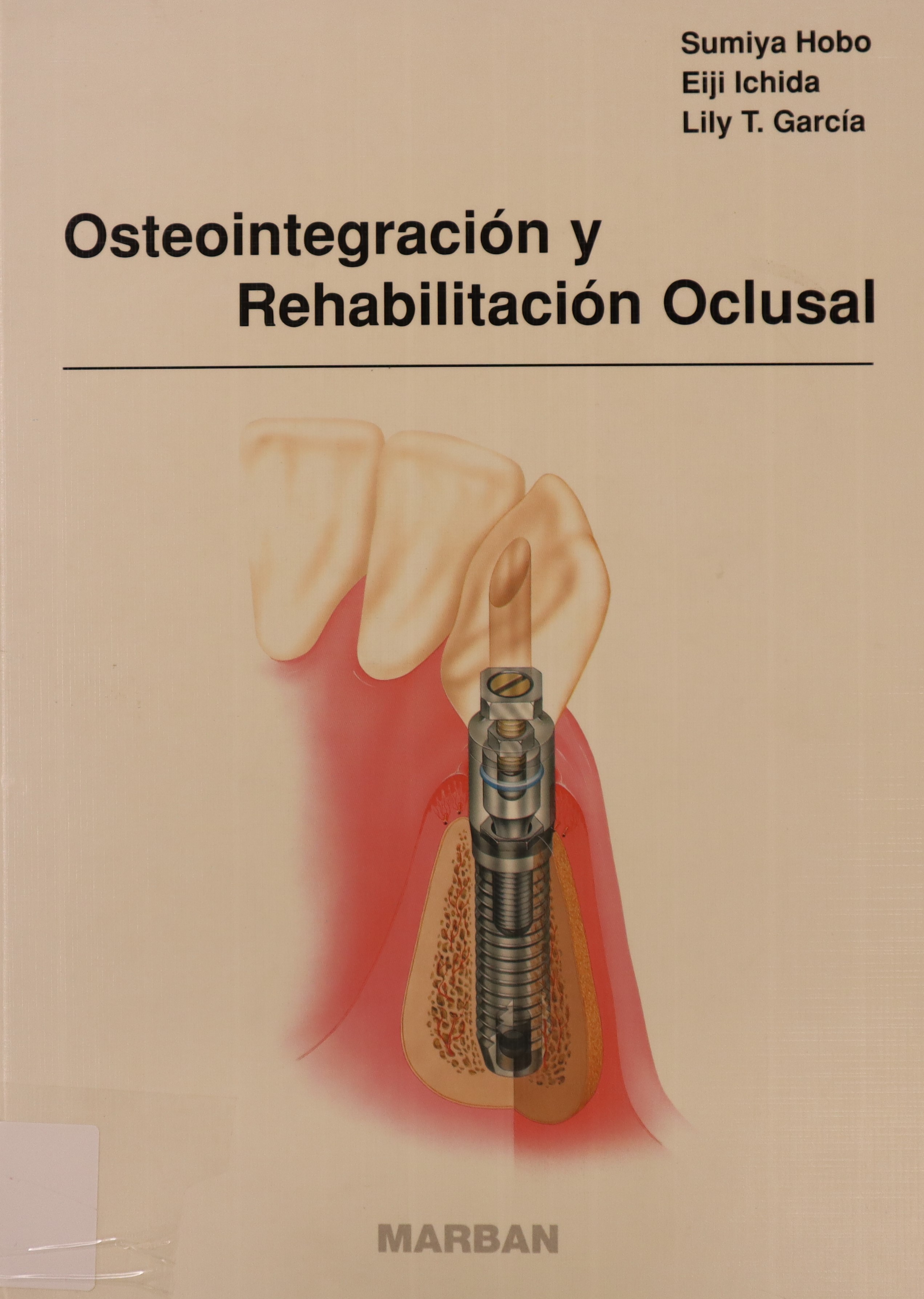 OSTEOINTEGRACIÓN Y REHABILITACIÓN OCLUSAL
