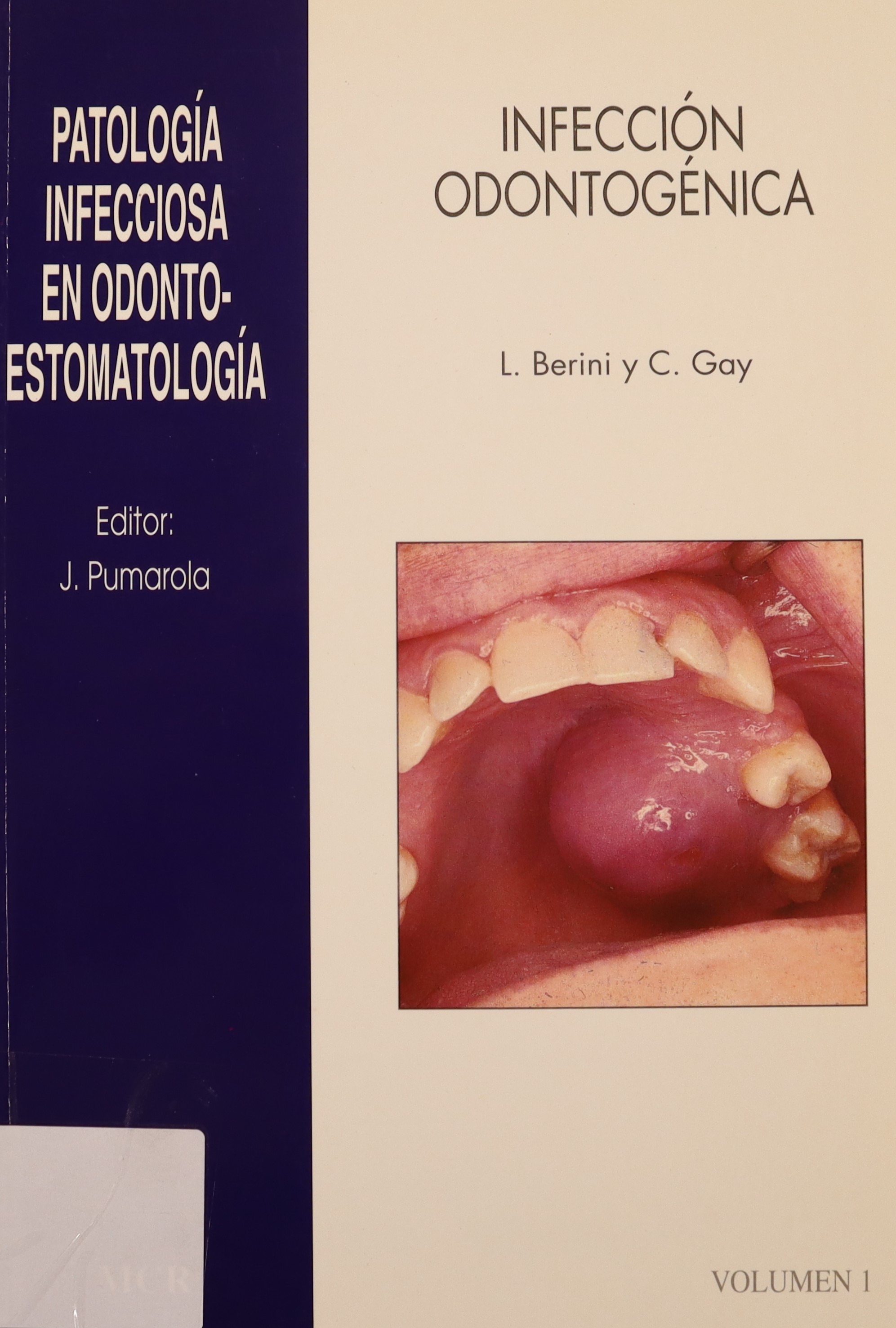 PATOLOGÍA INFECCIOSA EN ODONTO-ESTOMATOLOGÍA. INFECCIÓN ODONTOGÉNICA. VOL. 1.