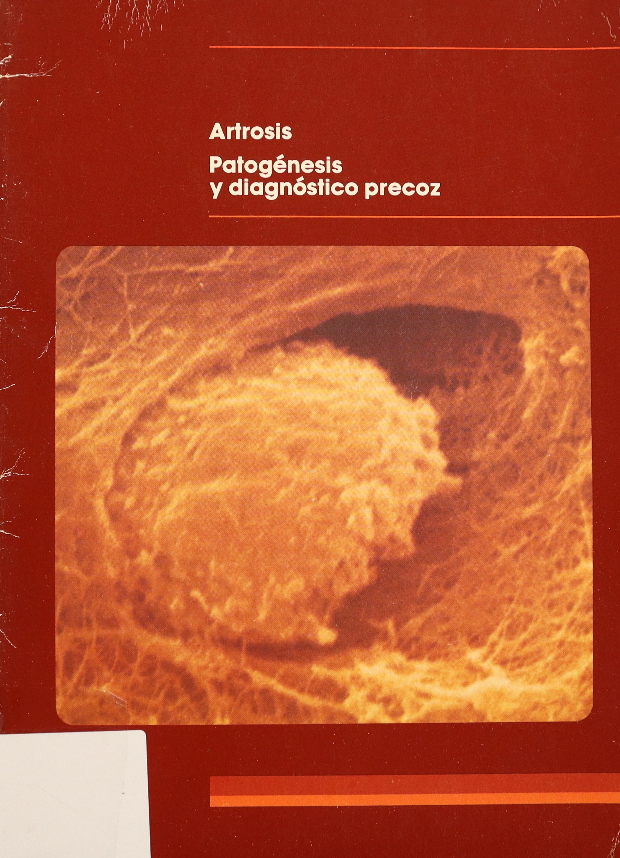 ARTROSIS-PATOGÉNESIS Y DIAGNÓSTICO PRECOZ