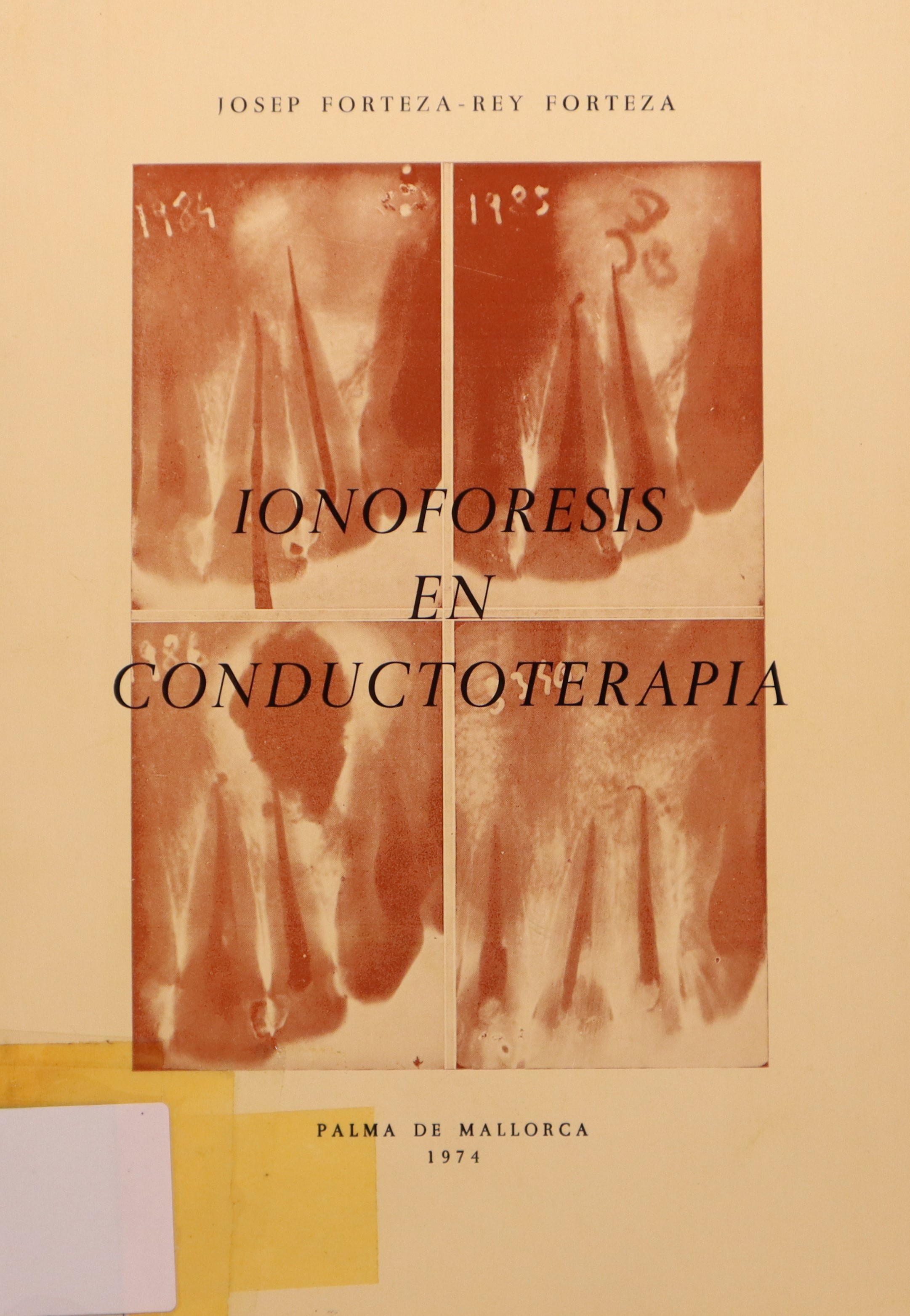 IONOFORESIS EN CONDUCTOTERAPIA