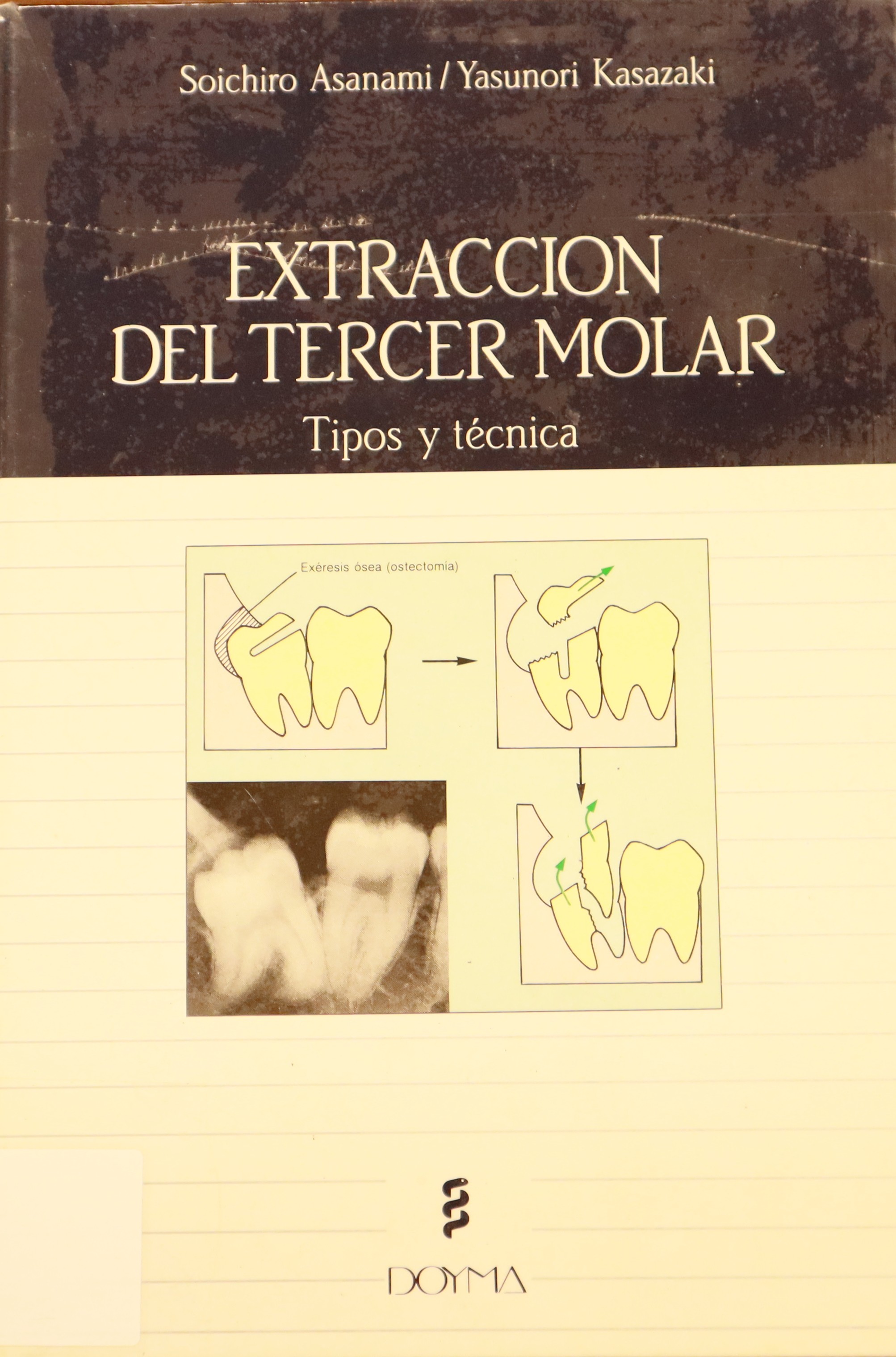 EXTRACCIÓN DEL TERCER MOLAR. TIPOS Y TÉCNICAS.