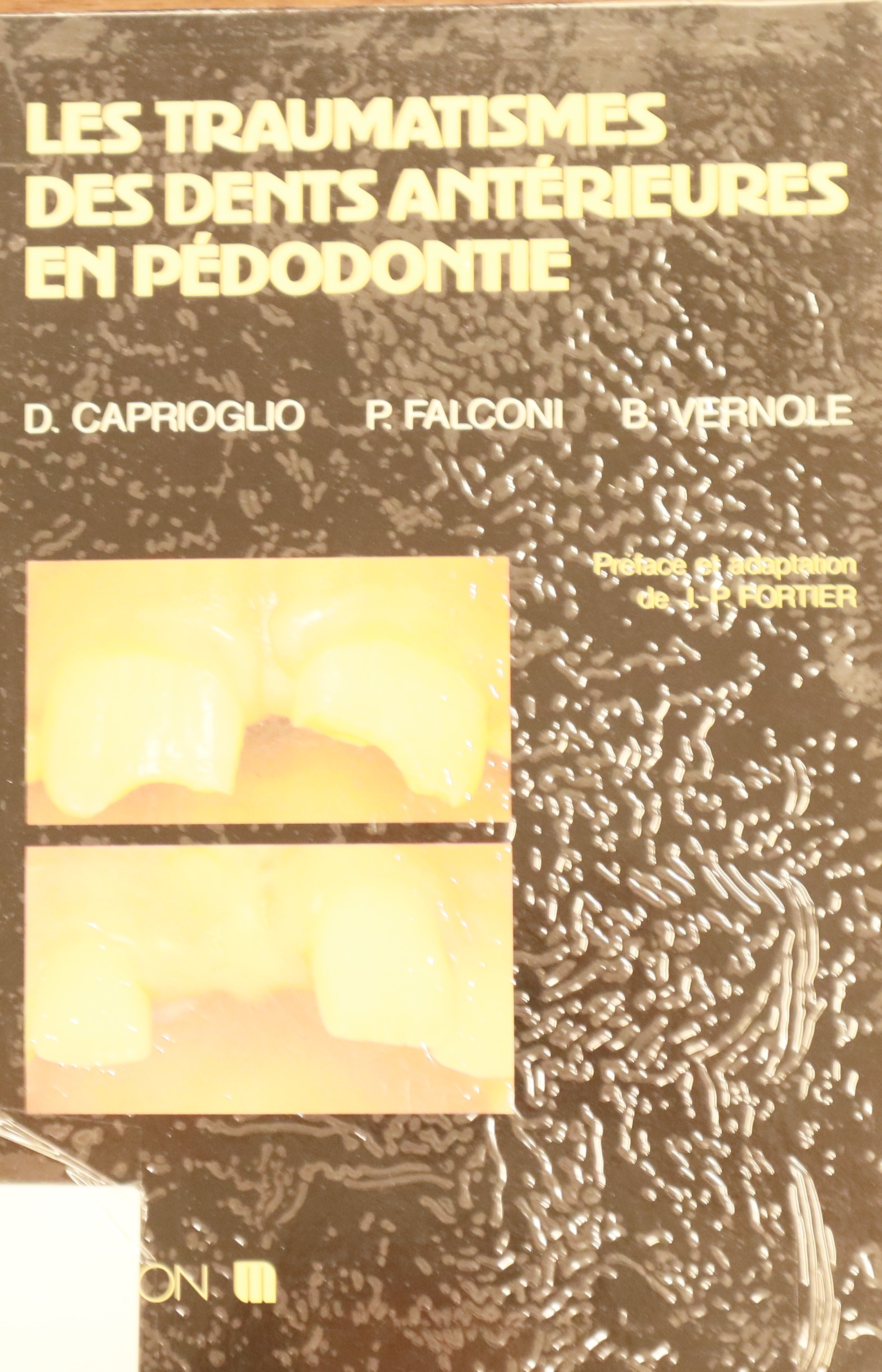 LES TRAUMATISMES DES DENTS ANTÉRIEURES EN PÉDODONTIE