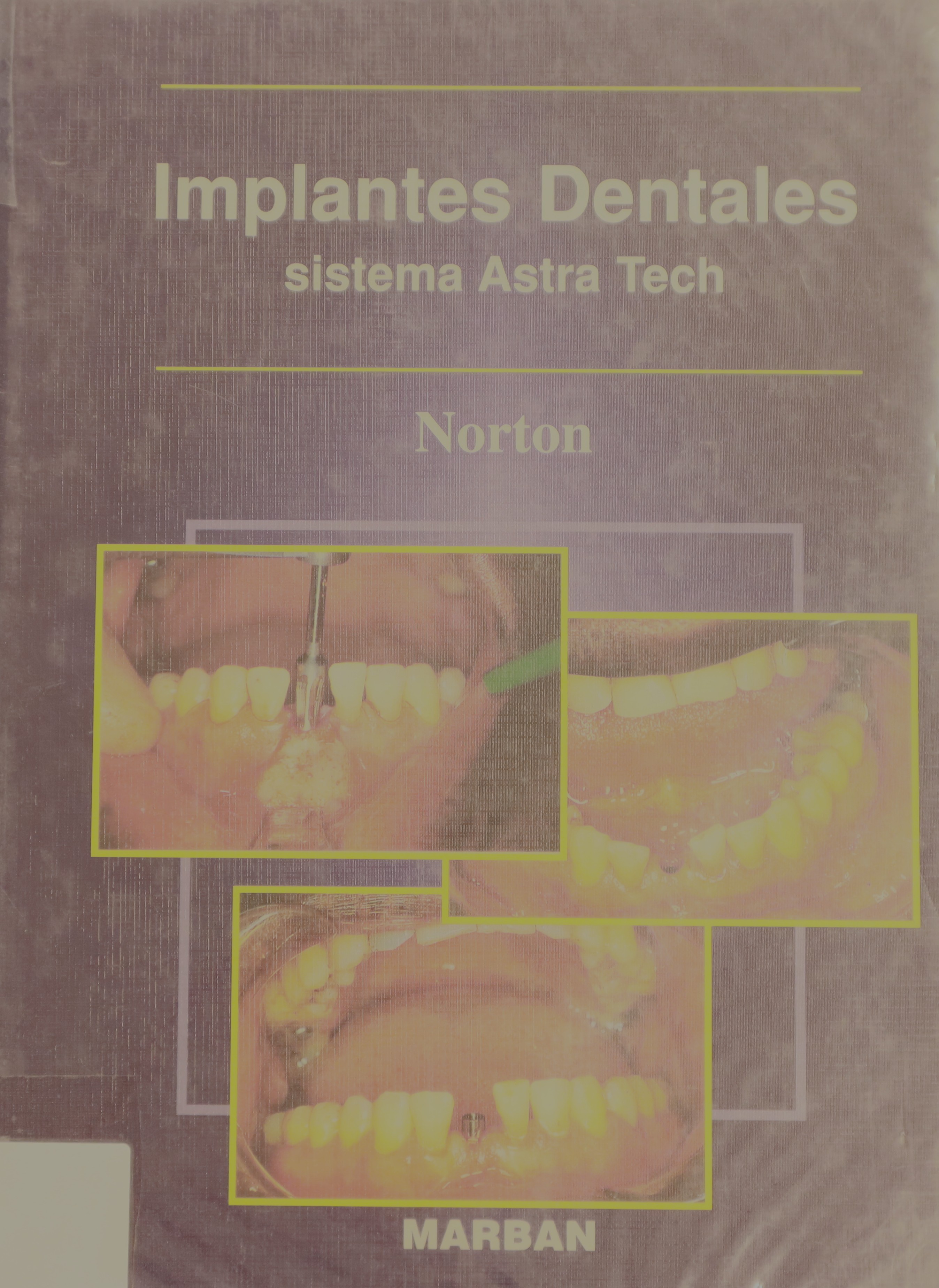 IMPLANTES DENTALES SISTEMA ASTRA TECH