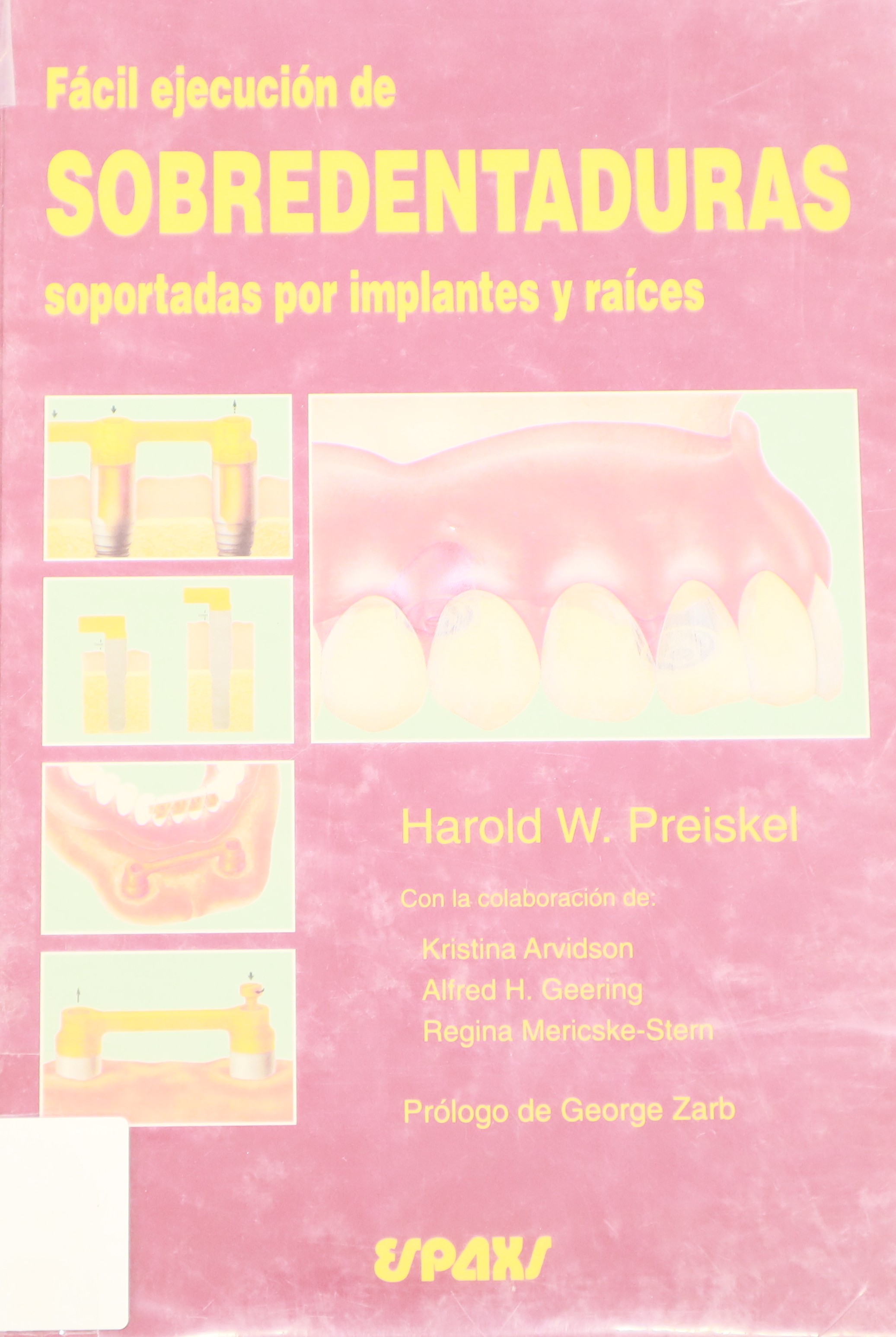FÁCIL EJECUCIÓN DE SOBREDENTADURAS SOPORTADAS POR IMPLANTES Y RAÍCES