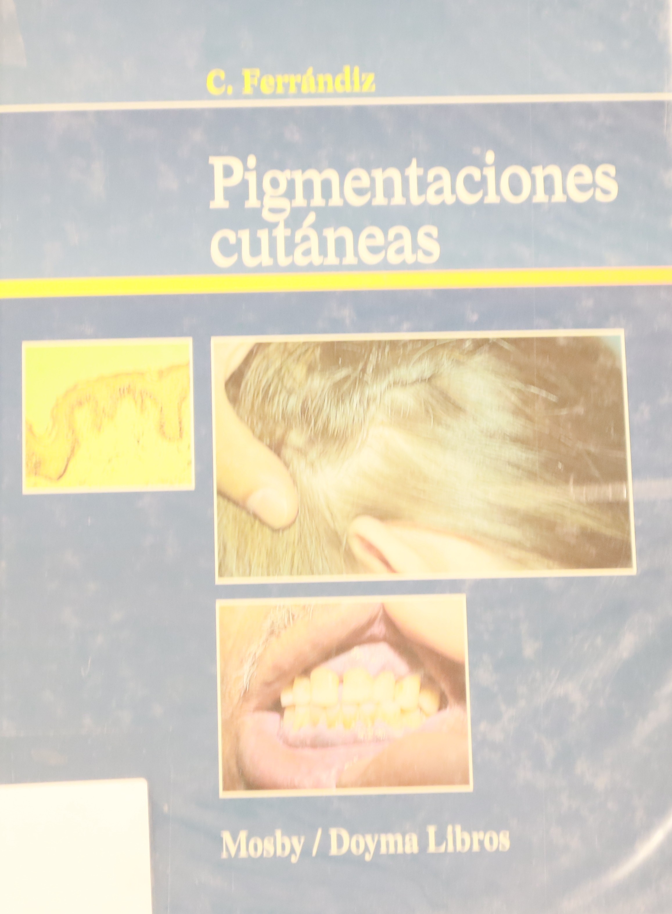 PIGMENTACIONES CUTÁNEAS