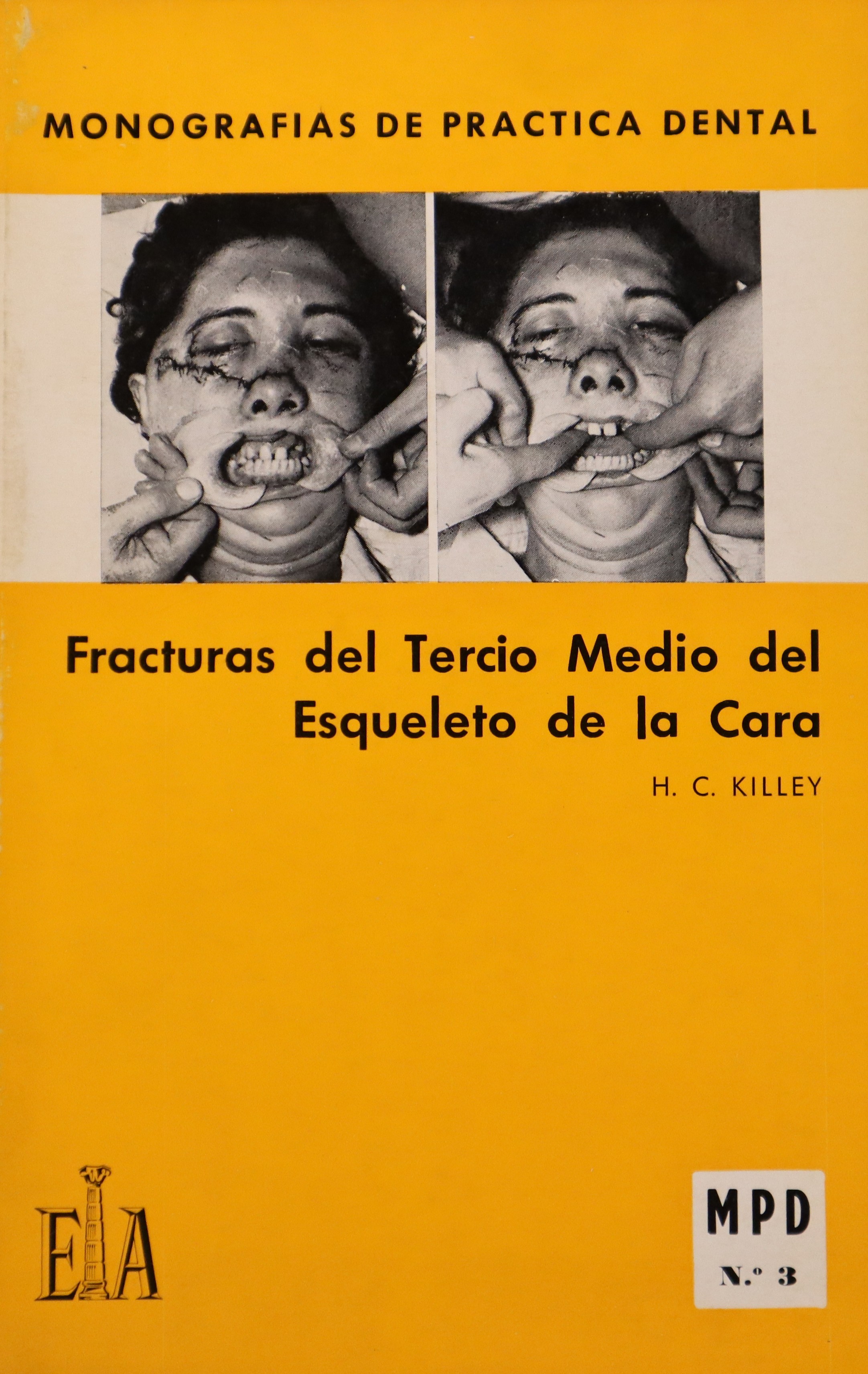 MONOGRAFÍAS DE PRÁCTICA DENTAL: FRACTURAS DEL TERCIO MEDIO DEL ESQUELETO DE LA CARA