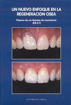 UN NUEVO ENFOQUE EN LA REGENERACIÓN OSEA: PLASMA RICO EN FACTORES DE CRECIMIENTO