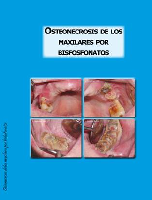 OSTEONECROSIS DE LOS MAXILARES POR BISFOSFONATOS