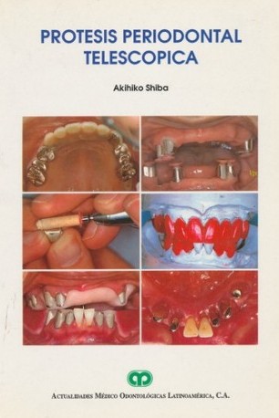 PRÓTESIS PERIODONTAL TELESCOPICA