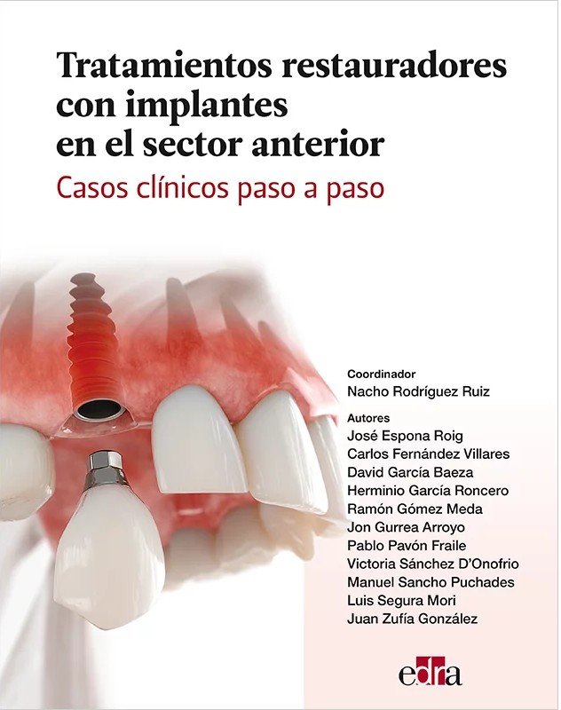 TRATAMIENTOS RESTAURADORES CON IMPLANTES EN EL SECTOR ANTERIOR. CASOS CLÍNICOS PASO A PASO.